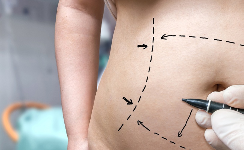 Weight Loss Surgery: 4 Ways To Prepare