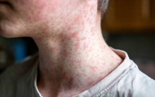 Blog - Measles in Wood County: How to Know If You’re Protected