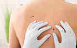 Identifying Symptoms of Skin Cancer