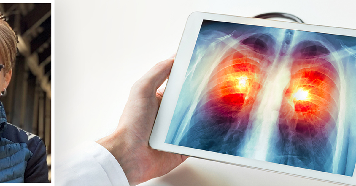 Lung Cancer Screening Navigation Program Wood County Hospital
