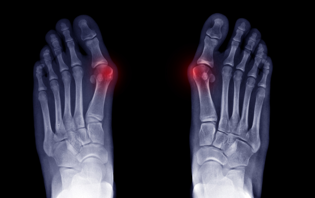 Lapiplasty 3D Bunion Correction Surgery